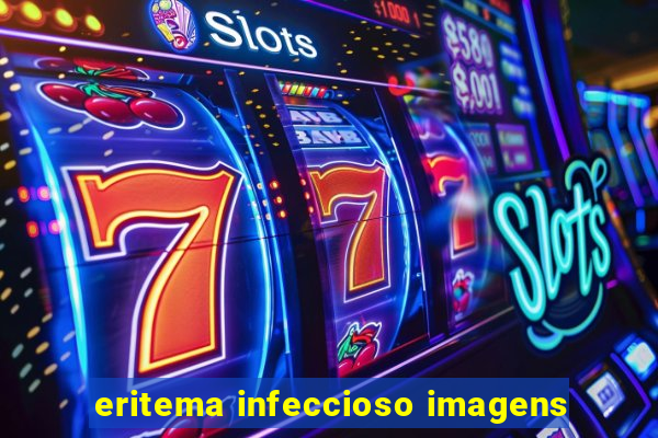 eritema infeccioso imagens