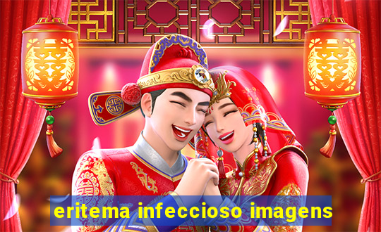 eritema infeccioso imagens